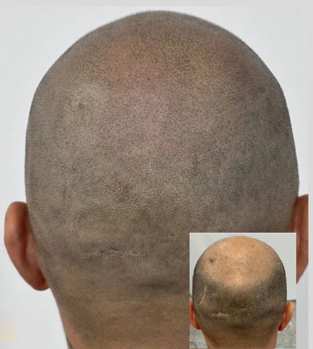 Resultado Micropigmentación Capilar